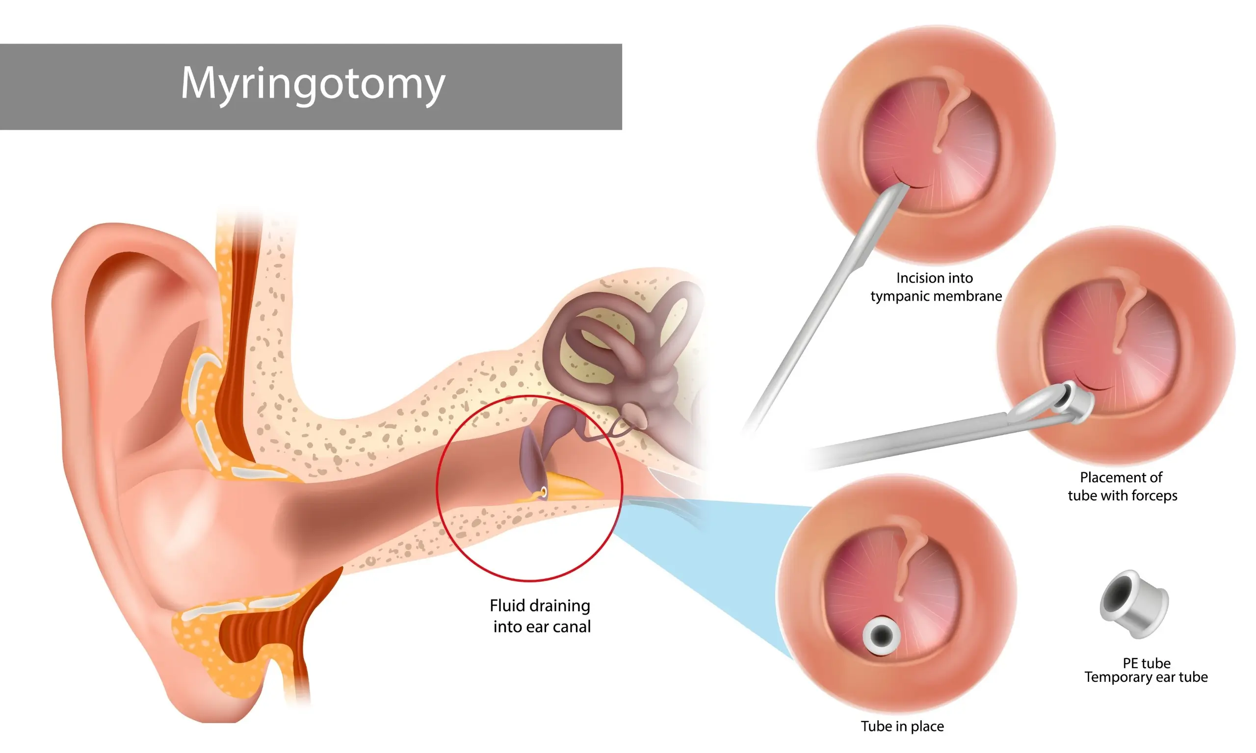 Myringotomy procedure diagram showing ear tube placement in the eardrum